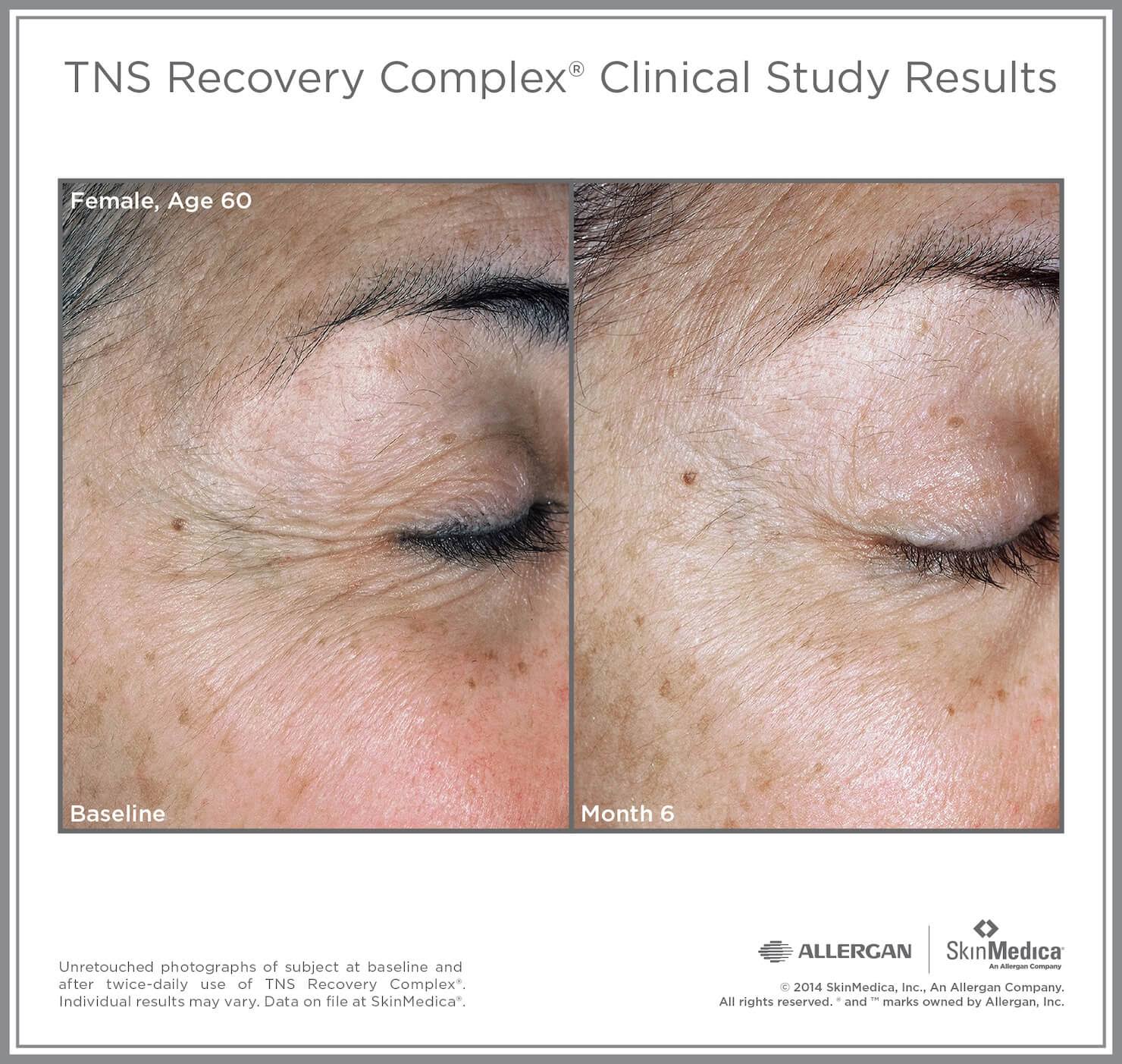 TNS Recovery Complex 0.63 oz Q85884